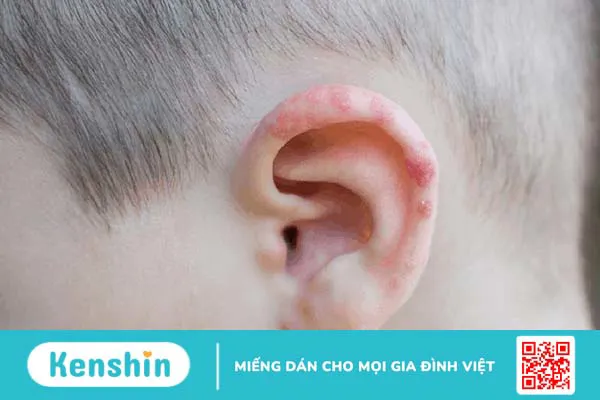 Liệt mặt vĩnh viễn do chủ quan khi bị Zona tai 3