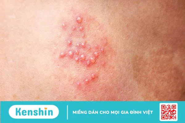 Bệnh zona thần kinh và Herpes khác nhau như thế nào?