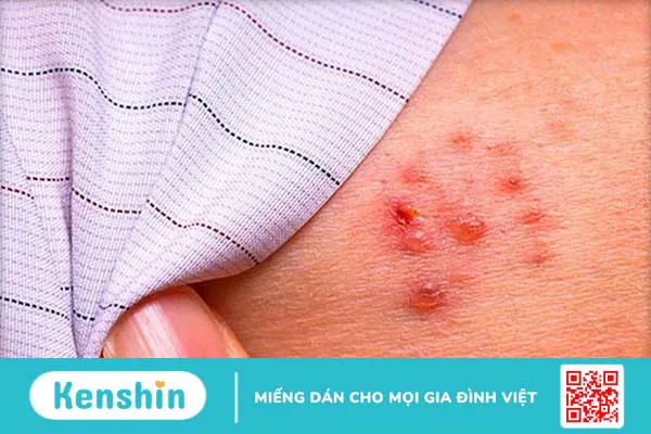 Bệnh zona thần kinh và Herpes khác nhau như thế nào?