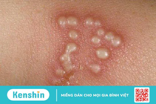 Bệnh zona thần kinh và Herpes khác nhau như thế nào?