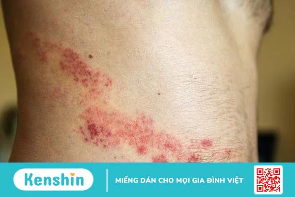 Bệnh zona thần kinh và Herpes khác nhau như thế nào?