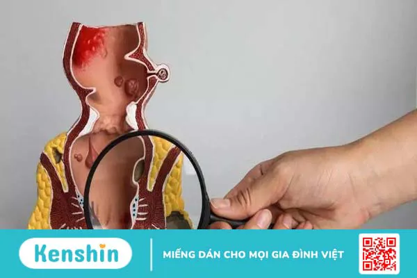 Bị bệnh sa trực tràng có nguy hiểm không?