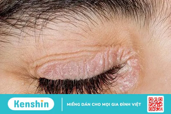 Bị bệnh vảy nến ở mí mắt phải làm thế nào?