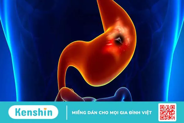 Bị đau bụng trên rốn sau khi ăn: Nguyên nhân và giải pháp 2