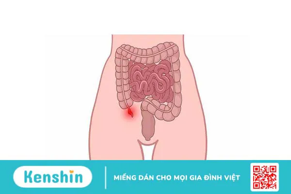 Bị đau bụng trên rốn sau khi ăn: Nguyên nhân và giải pháp 3