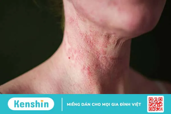 Bị dị ứng có nên tắm không, trường hợp nào không nên tắm?