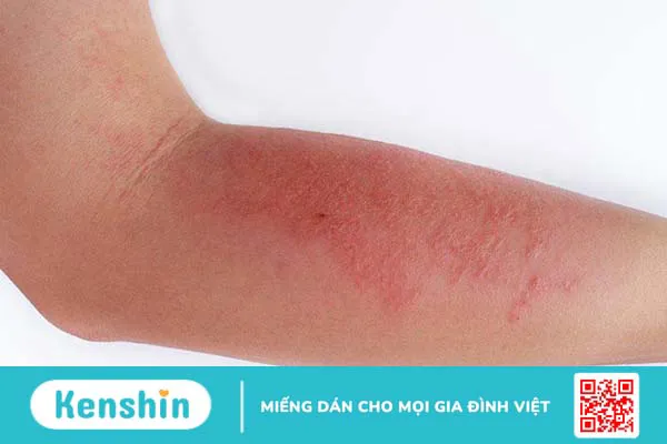 Bị dị ứng có nên tắm không, trường hợp nào không nên tắm? 2