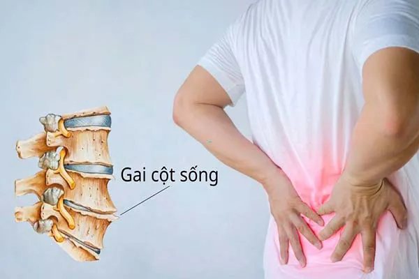 Bị gai cột sống có nên nằm nệm không? Cách chọn mua nệm hỗ trợ tốt cho lưng