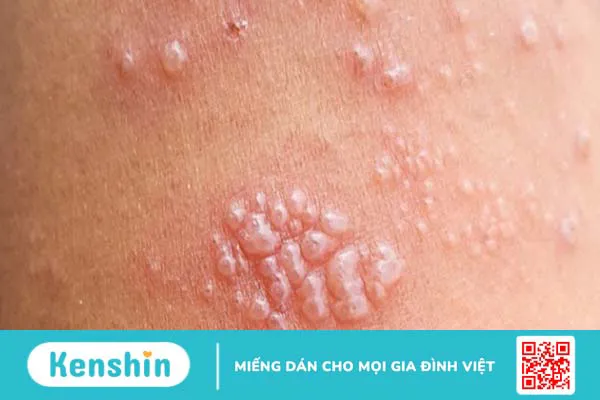 Bị giời leo kiêng ăn gì để nhanh hết bệnh?