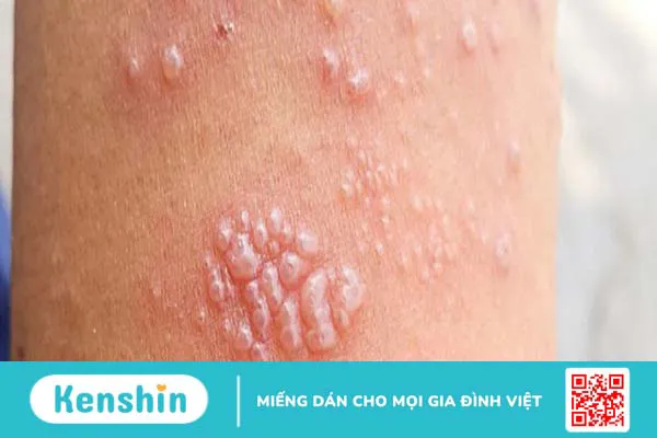 Bị giời leo kiêng ăn gì để nhanh hết bệnh? 1