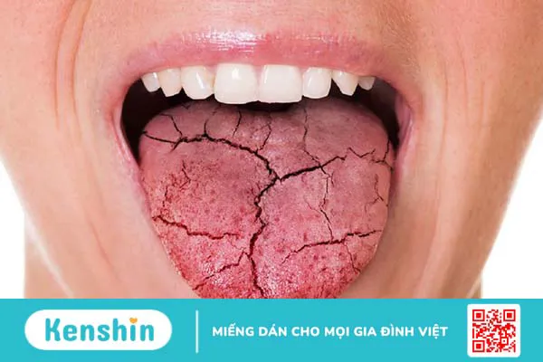 Bị khô miệng mệt mỏi là dấu hiệu cảnh báo gì?