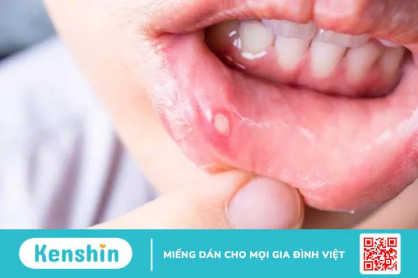 Bị loét ở lưỡi không thấy đau có phải dấu hiệu ung thư lưỡi?