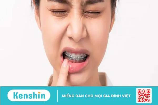 Bị nhiệt miệng khi niềng răng phải làm sao? Cách xử lý hiệu quả