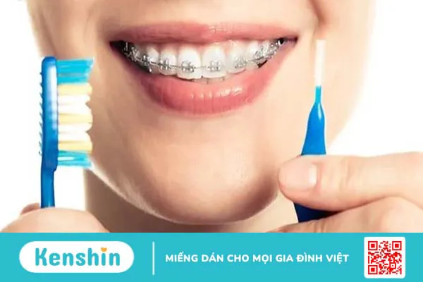 Bị nhiệt miệng khi niềng răng phải làm sao? Cách xử lý hiệu quả