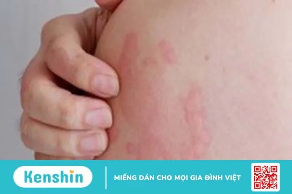 Bị phong ngứa nguyên nhân do đâu? Phương pháp điều trị và phòng tránh bệnh phong ngứa