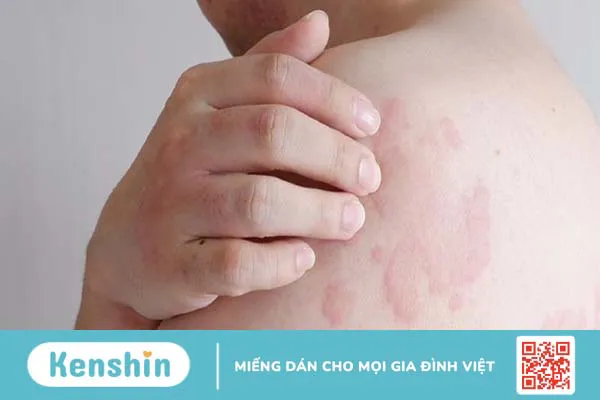 Bị phong ngứa nguyên nhân do đâu? Phương pháp điều trị và phòng tránh bệnh phong ngứa