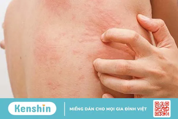 Bị phong ngứa nguyên nhân do đâu? Phương pháp điều trị và phòng tránh bệnh phong ngứa