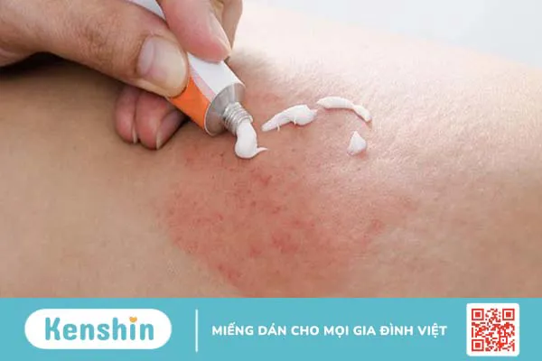 Bị phong ngứa nguyên nhân do đâu? Phương pháp điều trị và phòng tránh bệnh phong ngứa