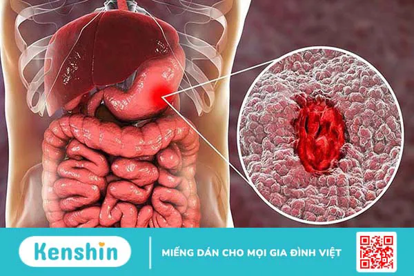 Biểu hiện lâm sàng bệnh Amyloidosis