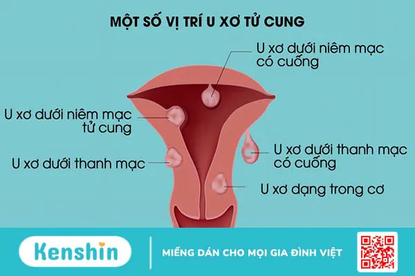 Bóc u xơ tử cung có mất máu nhiều không?