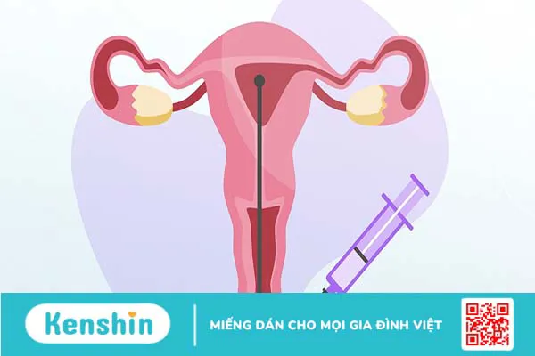 Bơm IUI sau 7 ngày có gì khác không? Một số dấu hiệu có thai sau IUI 7 ngày