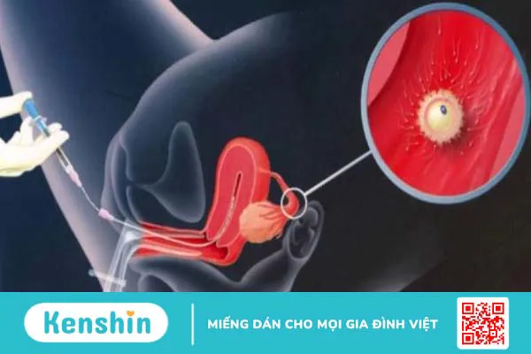 Bơm IUI sau 7 ngày có gì khác không? Một số dấu hiệu có thai sau IUI 7 ngày