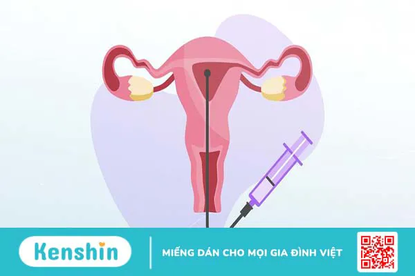 Bơm IUI sau 7 ngày có gì khác không? Một số dấu hiệu có thai sau IUI 7 ngày