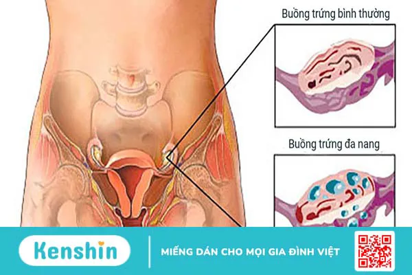 Buồng trứng: Cấu tạo, chức năng và các bệnh lý phổ biến liên quan đến buồng trứng