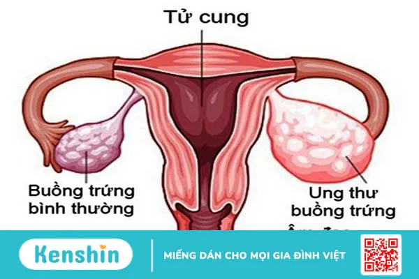 Buồng trứng: Cấu tạo, chức năng và các bệnh lý phổ biến liên quan đến buồng trứng