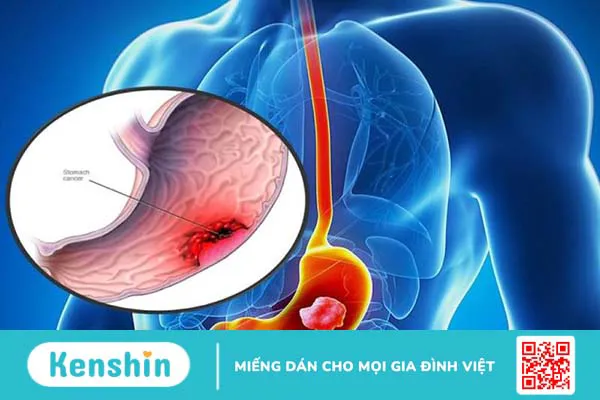 Ca 72.4 là gì? Xét nghiệm ca 72-4 có ý nghĩa gì? 1