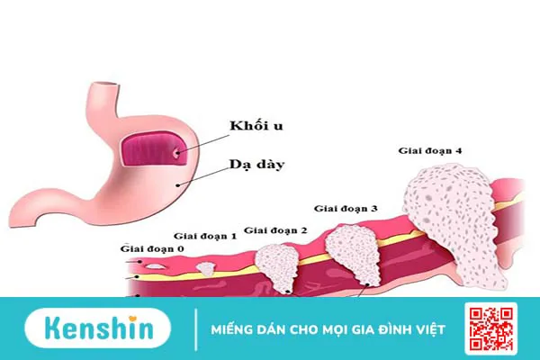 Ca 72.4 là gì? Xét nghiệm ca 72-4 có ý nghĩa gì? 2