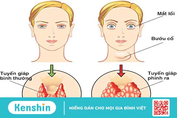 Các bệnh nội tiết thường gặp và cách điều trị dứt điểm 3