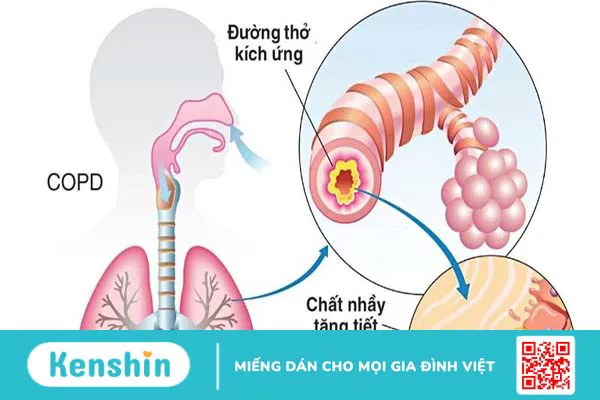 Các bệnh về hô hấp thường gặp và cách phòng ngừa