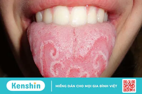 Các bệnh về lưỡi ở trẻ em thường mắc phải, mẹ đã biết?