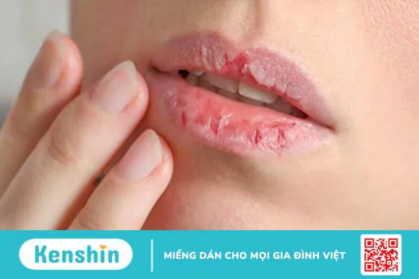 Các bệnh về môi: Nguyên nhân, triệu chứng và điều trị 2