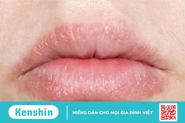 Các bệnh về môi: Nguyên nhân, triệu chứng và điều trị 3