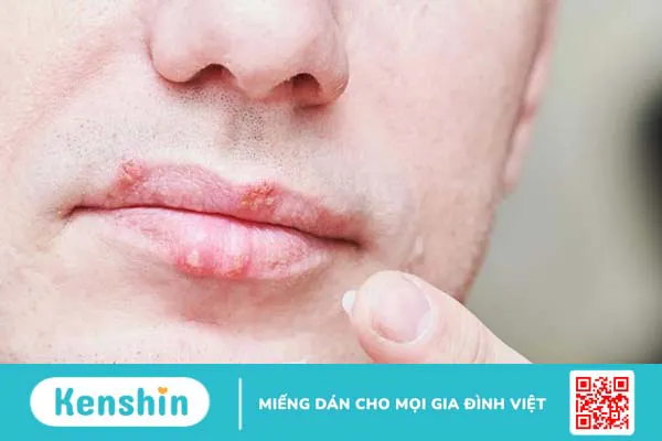 Các bệnh về môi: Nguyên nhân, triệu chứng và điều trị 6