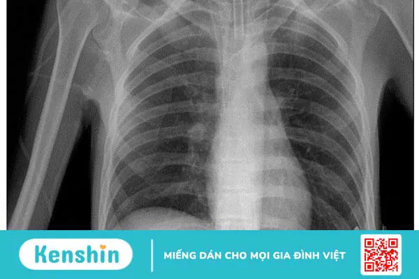 Các bước đọc X quang ngực cơ bản: Hướng dẫn và phân tích kết quả