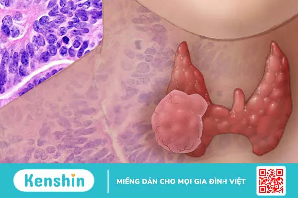 Các chỉ số xét nghiệm máu ung thư tuyến giáp người bệnh cần nắm