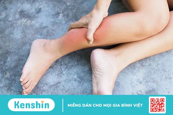 Các dạng viêm cơ chân phổ biến 1