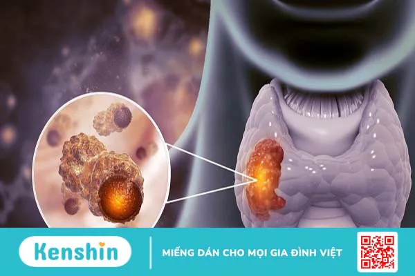 Các giai đoạn ung thư tuyến giáp và cách phân loại giai đoạn ung thư