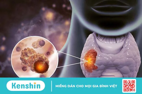 Các giai đoạn ung thư tuyến giáp và cách phân loại giai đoạn ung thư