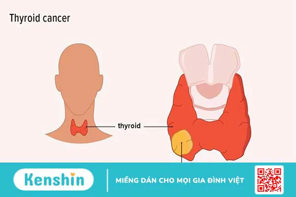 Các giai đoạn ung thư tuyến giáp và cách phân loại giai đoạn ung thư