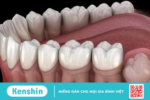 Các kiểu răng khôn mọc lệch thường gặp