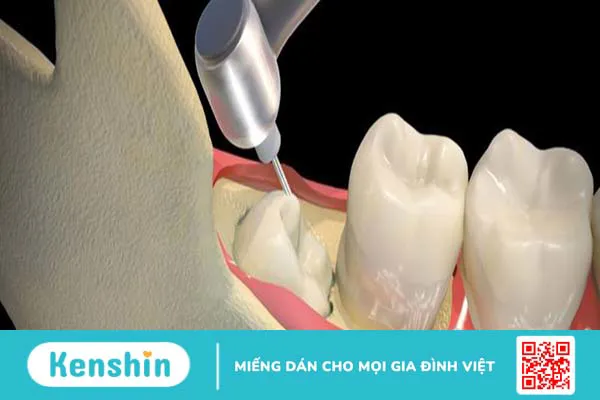 Các kiểu răng khôn mọc lệch thường gặp