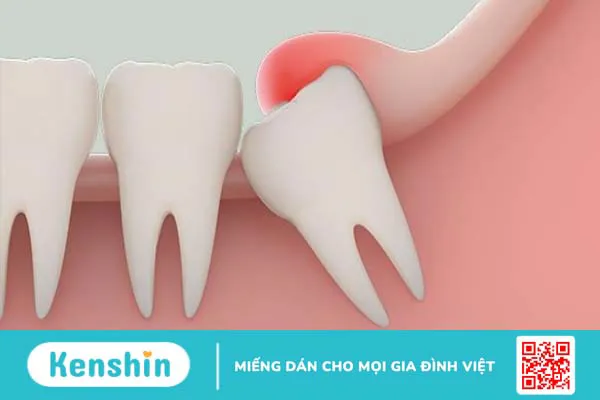 Các kiểu răng khôn mọc lệch thường gặp