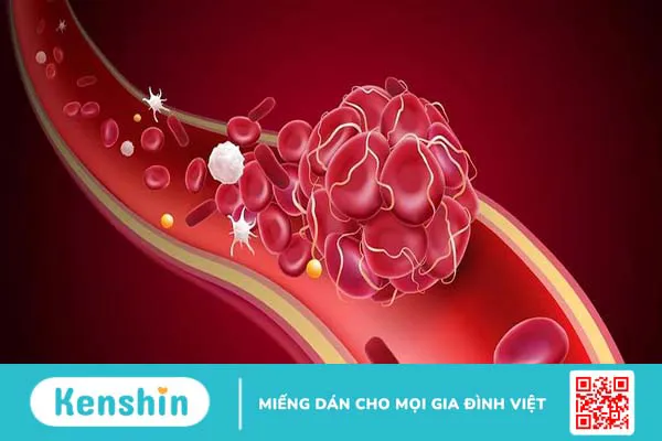 Các loại cục máu đông thường gặp và quá trình hình thành cục máu đông