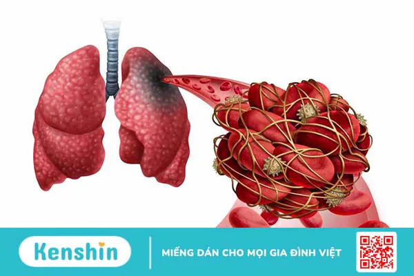 Các loại cục máu đông thường gặp và quá trình hình thành cục máu đông