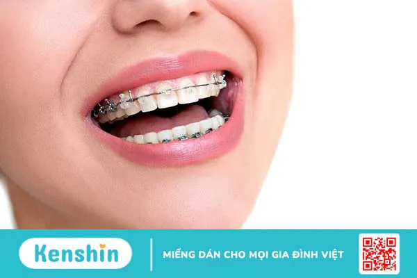 Các loại dây cung trong chỉnh nha