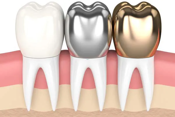 Các loại răng sứ thẩm mỹ phổ biến hiện nay